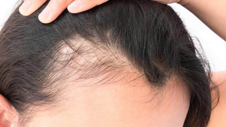 Causes de la chute des cheveux chez les femmes après 40 ans
