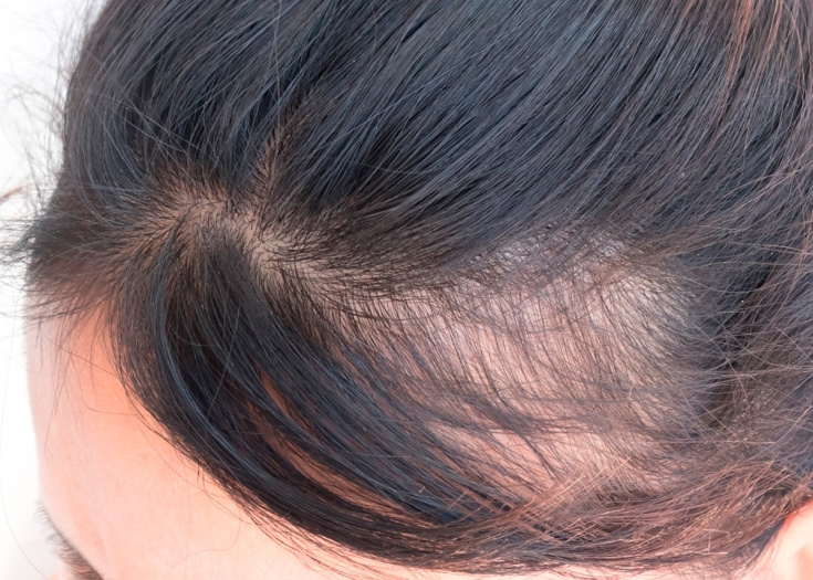 Causes de la chute des cheveux chez les femmes après 40 ans