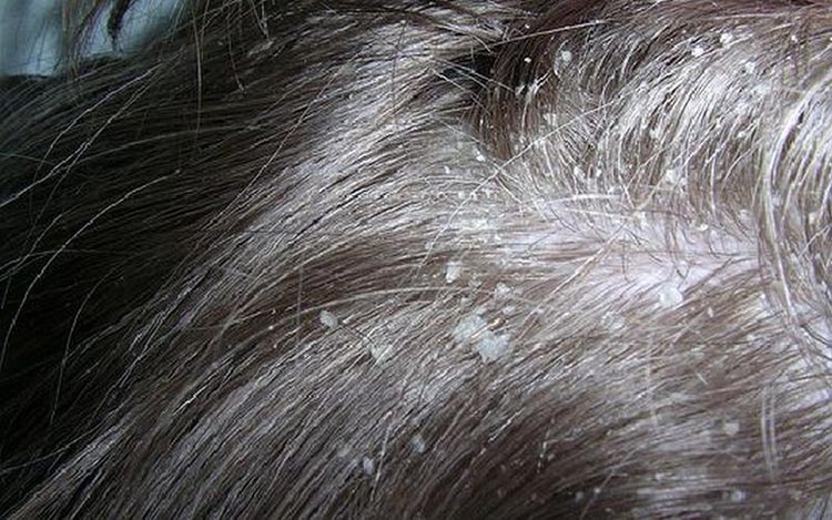 Masques antipelliculaires faits maison pour les cheveux