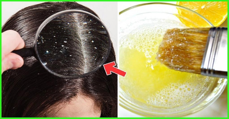 Masques antipelliculaires faits maison pour les cheveux