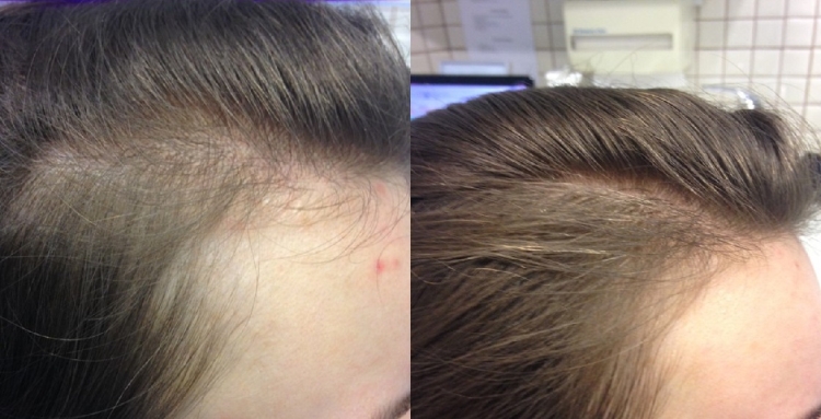 Remèdes populaires pour la perte de cheveux chez les femmes à la maison