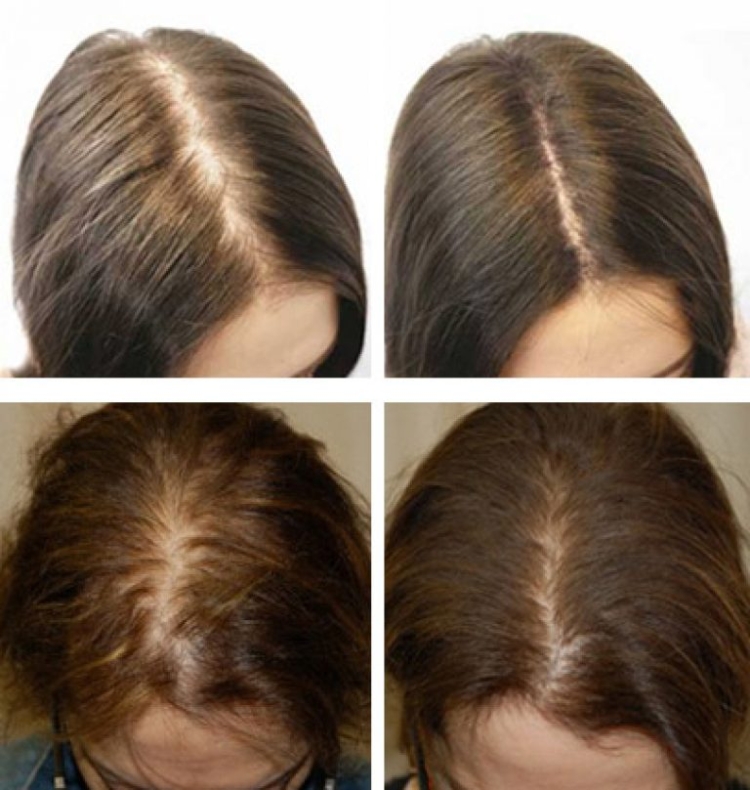 Remèdes populaires pour la perte de cheveux chez les femmes à la maison