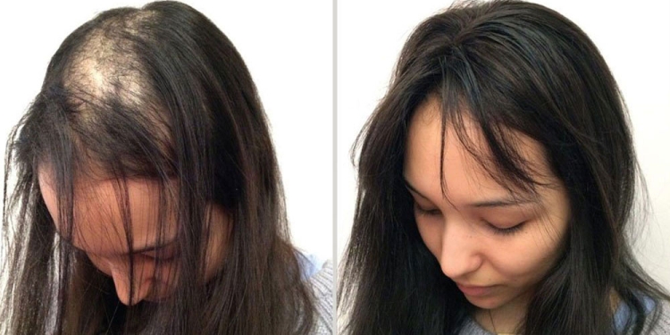 Remèdes populaires pour la perte de cheveux chez les femmes à la maison