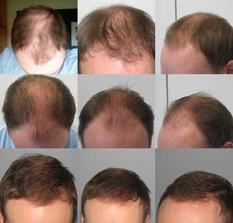 La restauration des cheveux de Jack