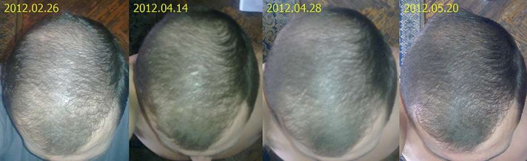 La restauration des cheveux de Jack
