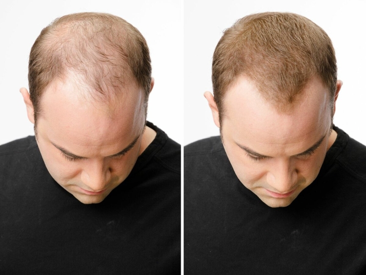 La restauration des cheveux de Jack