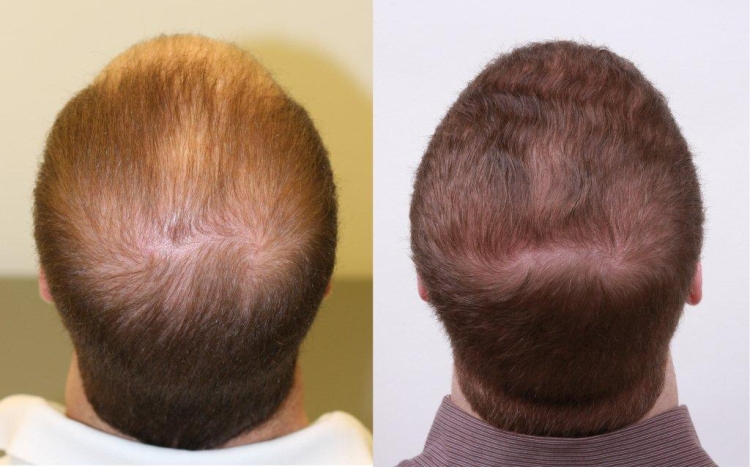 La restauration des cheveux de Jack