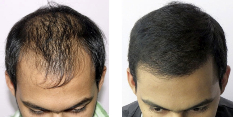 La restauration des cheveux de Jack