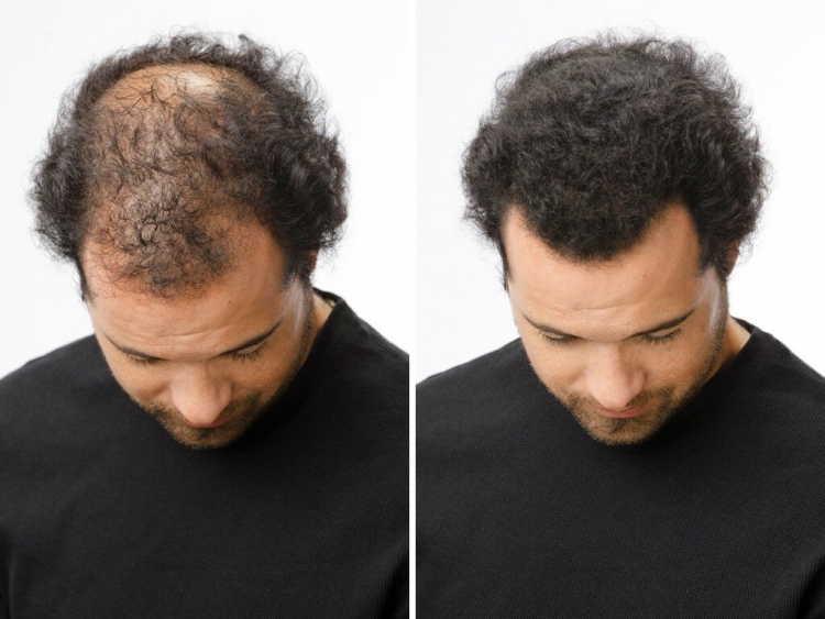 La restauration des cheveux de Jack