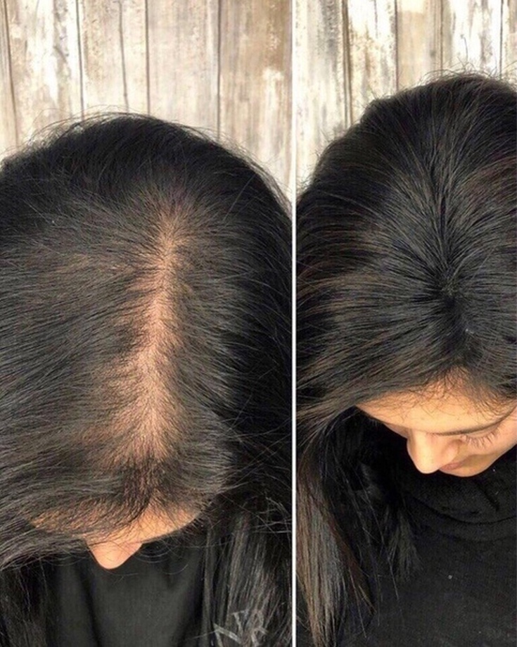 Perte de cheveux due au stress