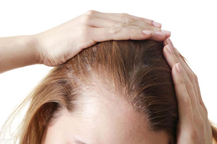Perte de cheveux due au stress