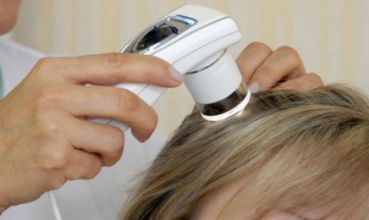 Perte de cheveux due au stress