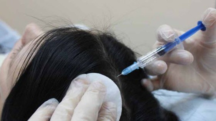 Thérapie à l'ozone pour le cuir chevelu