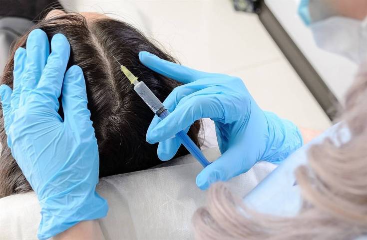 Thérapie à l'ozone pour le cuir chevelu
