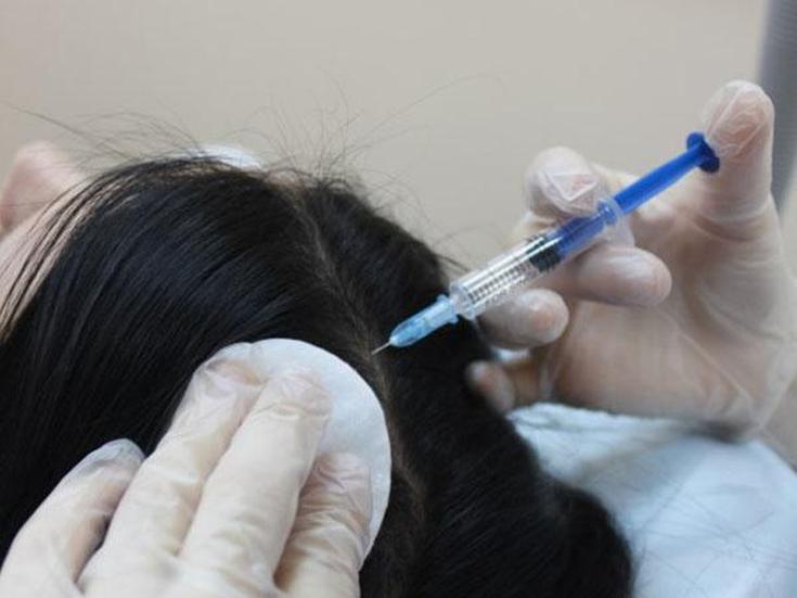 Plasmolifting pour la chute des cheveux