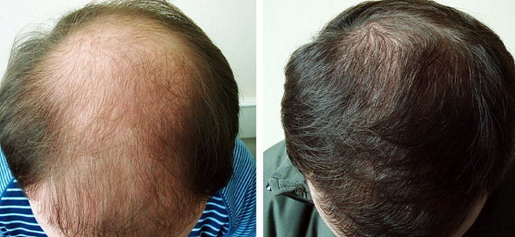 Plasmolifting pour la chute des cheveux