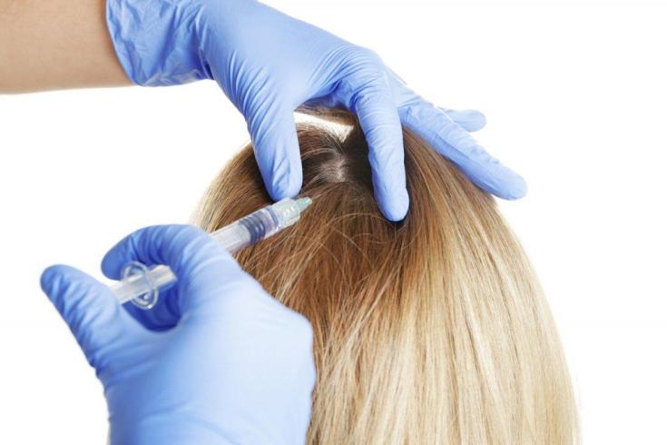 Plasmolifting pour la chute des cheveux