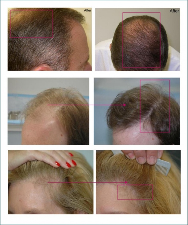 Plasmolifting pour la chute des cheveux