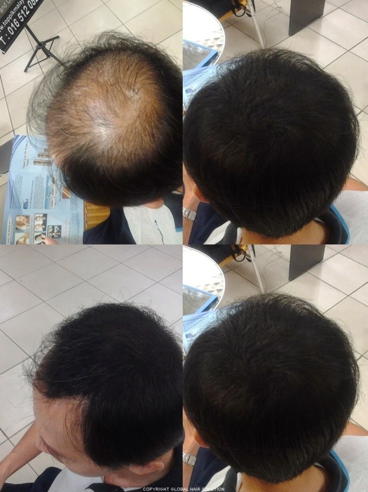 Top 5 des meilleurs épaississants pour cheveux