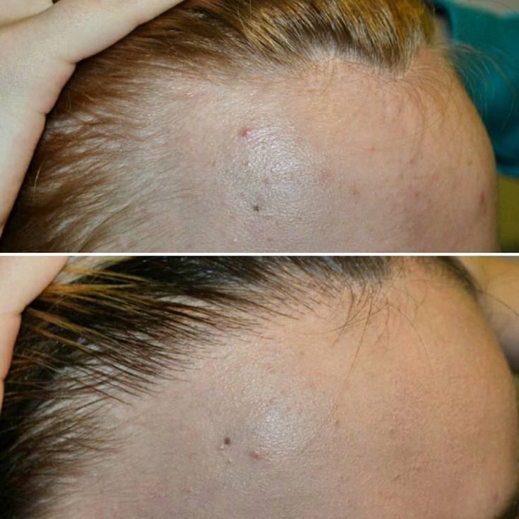 Plasmolifting pour la chute des cheveux