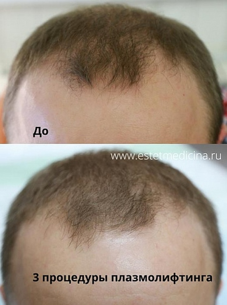 Plasmolifting pour la chute des cheveux